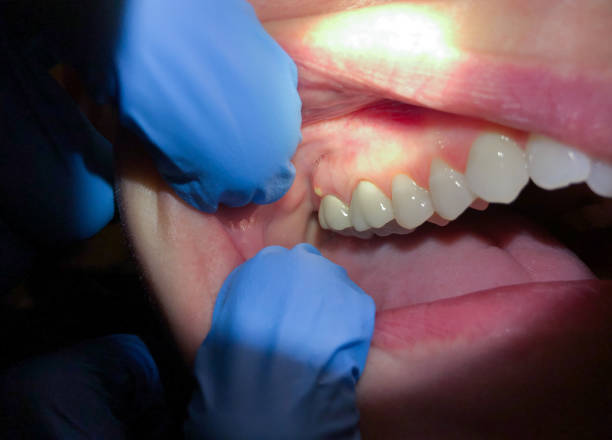 Best Emergency Root Canal Treatment in Broken Bow, NE
